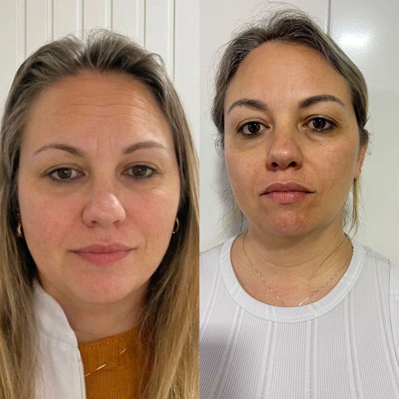 Resultado Facial